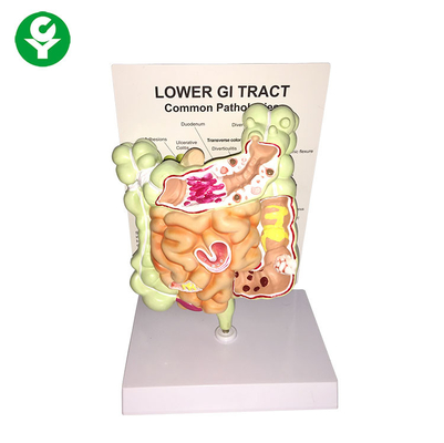 Lower Gi Tract Common Patology Model 20X15X16 Cm Ukuran Paket Tunggal